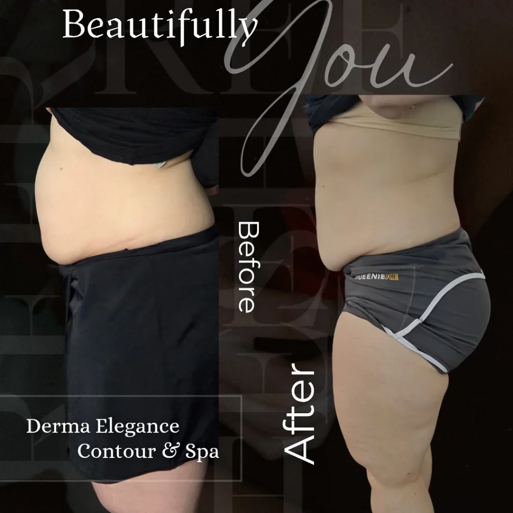 Before and after abdomen contouring with 10D Laser lipo in Woodstock Ontario.
