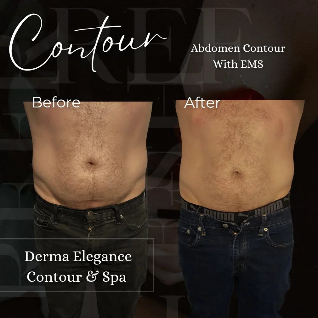Abdomen body contouring - before and after customized treatments designed to help reduce stubborn fat, improve body shape, and create a more sculped abdomen. Treatment plan may include 10d Laser Lipo, cavitation, EMS, vacuum therapy, and RF skin tightening based on your goals